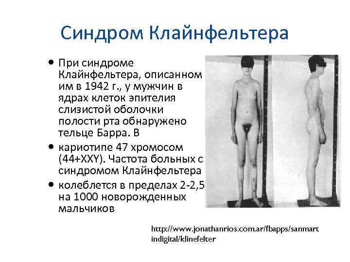  Синдром Клайнфельтера  При синдроме  Клайнфельтера, описанном  им в 1942 г.