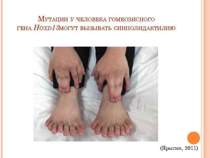  МУТАЦИИ У ЧЕЛОВЕКА ГОМЕОЗИСНОГО ГЕНА НОХD 13 ОГУТ ВЫЗЫВАТЬ СИНПОЛИДАКТИЛИЮ  М 