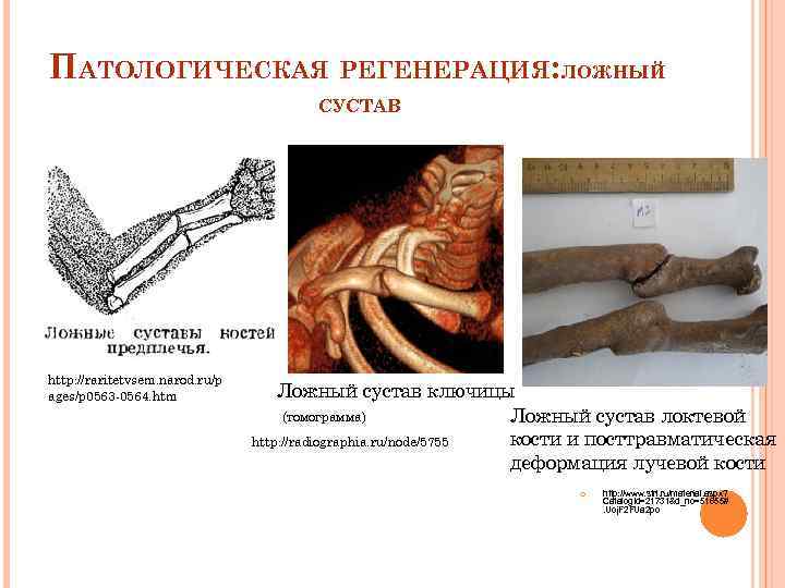 ПАТОЛОГИЧЕСКАЯ РЕГЕНЕРАЦИЯ: ЛОЖНЫЙ    СУСТАВ http: //raritetvsem. narod. ru/p ages/p 0563 -0564.