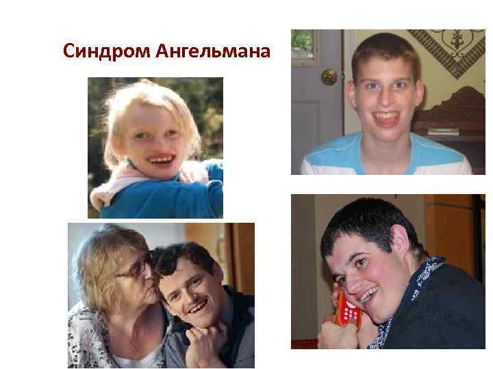 Синдром Ангельмана Синдром Ангельмана