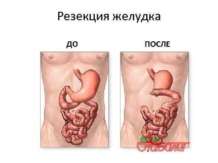 Резекция желудка 