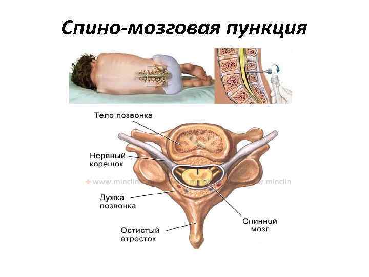 Спино-мозговая пункция 