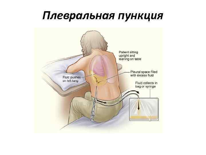Плевральная пункция 