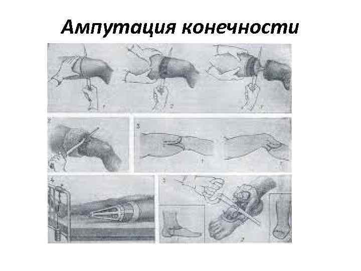 Ампутация конечности 