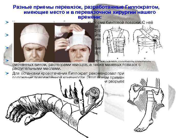 Разные приемы перевязок, разработанные Гиппократом, имеющие место и в перевязочной хирургии нашего  