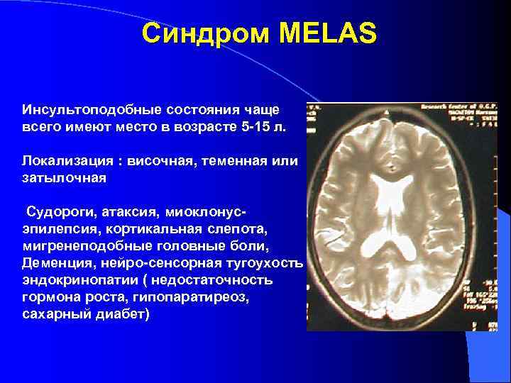     Синдром MELAS Инсультоподобные состояния чаще всего имеют место в возрасте