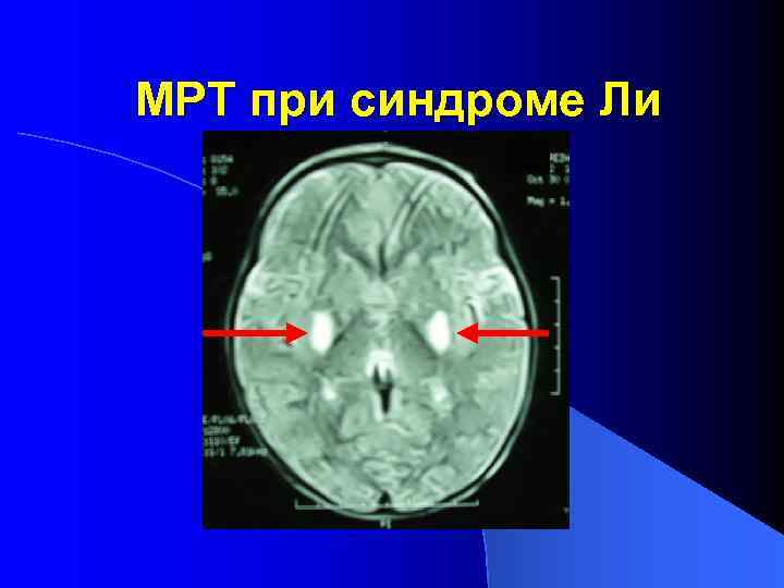 МРТ при синдроме Ли 