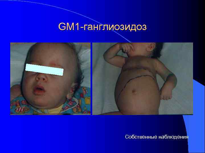 GM 1 -ганглиозидоз   Собственные наблюдения 