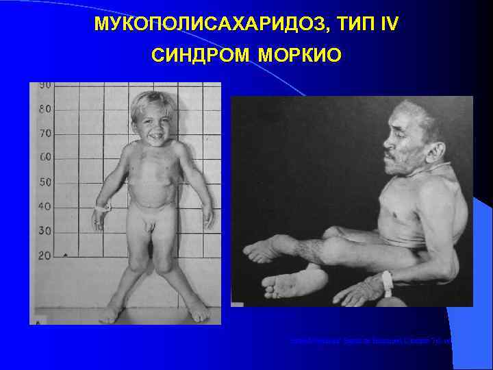 МУКОПОЛИСАХАРИДОЗ, ТИП IV СИНДРОМ МОРКИО     from Metabolic Basis of Inherited