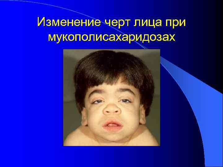Изменение черт лица при мукополисахаридозах 
