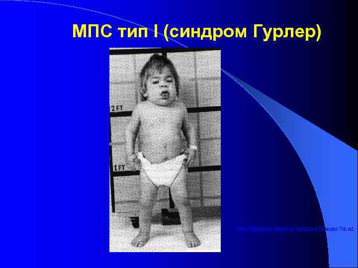 МПС тип I (синдром Гурлер)     from Metabolic Basis of Inherited