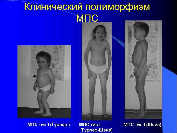 Клинический полиморфизм  МПС тип I (Гурлер )  МПС тип I (Шейе) 