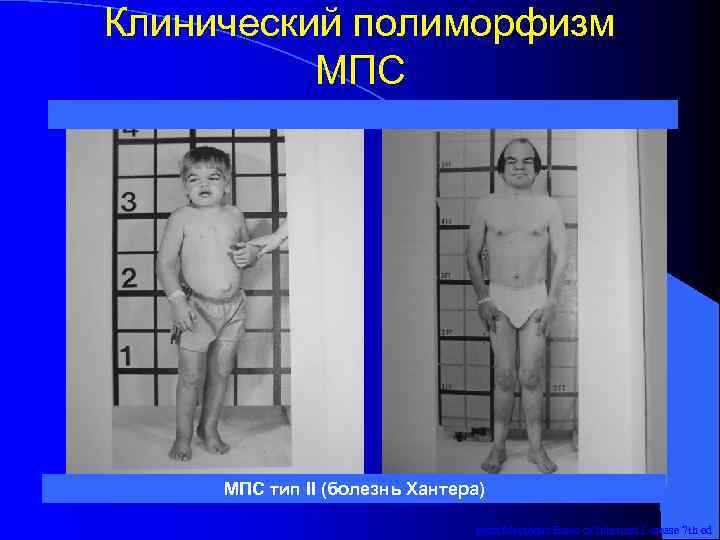 Клинический полиморфизм  МПС тип II (болезнь Хантера)      