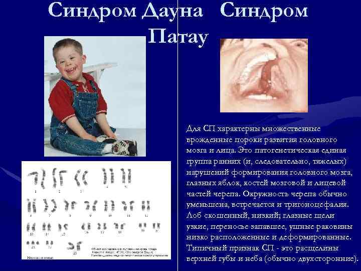 Синдром Дауна Синдром   Патау   Для СП характерны множественные  врожденные