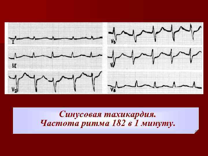 Частота ритма. Синусовая тахикардия на ЭКГ. Синусовая тахикардия частота. Пароксизмальная тахикардия ЭКГ. Синусовая тахикардия с частотой 91.