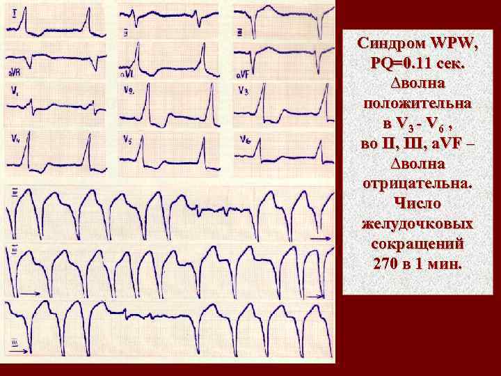 Wpw синдром на экг картинки