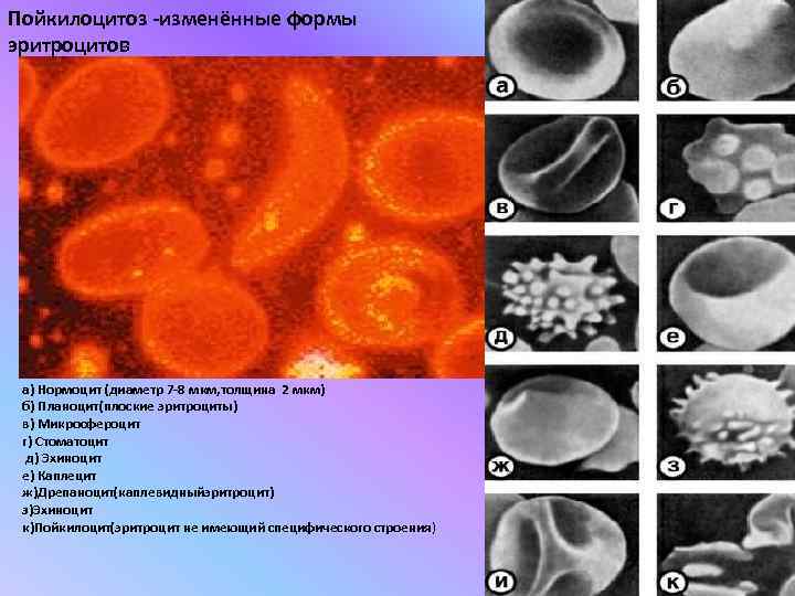 Пойкилоцитоз -изменённые формы эритроцитов а) Нормоцит (диаметр 7 -8 мкм, толщина 2 мкм) б)