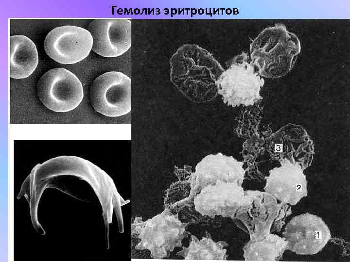 Гемолиз эритроцитов 