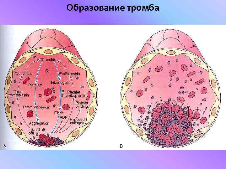 Схема образования сгустка в просвете сосуда