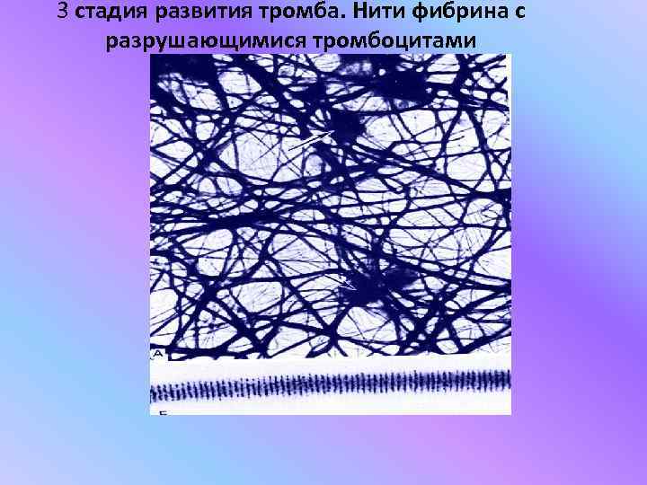 3 стадия развития тромба. Нити фибрина с разрушающимися тромбоцитами 