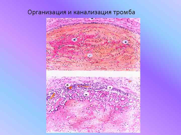 Организация и канализация тромба 