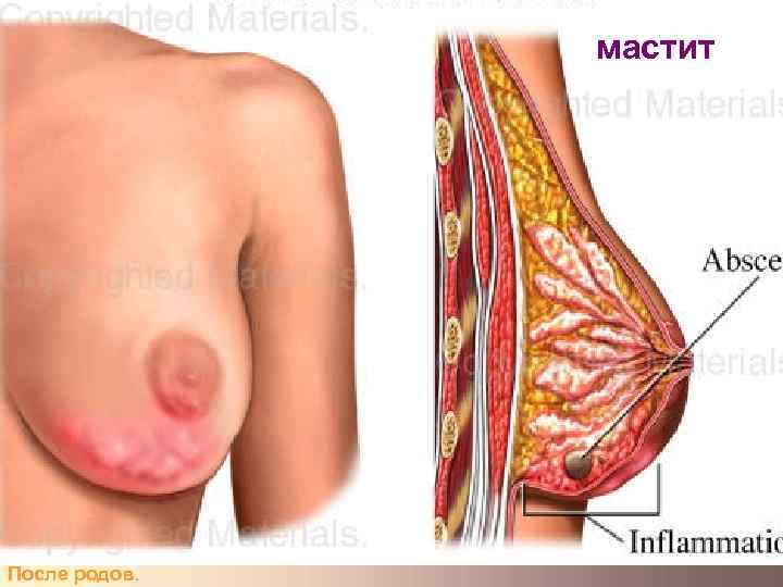     мастит После родов.  