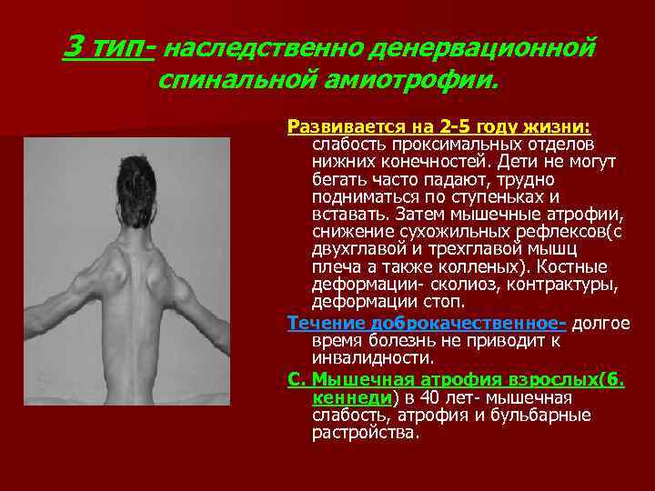 3 тип- наследственно денервационной  спинальной амиотрофии.    Развивается на 2 -5