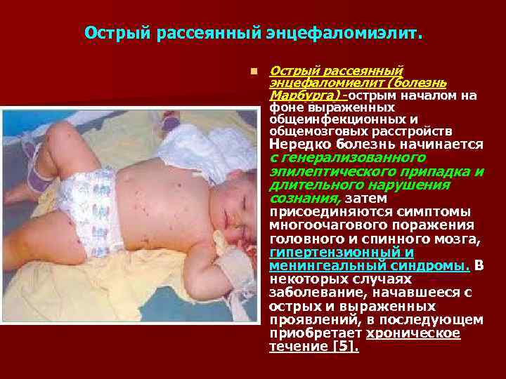 Острый рассеянный энцефаломиэлит.    n  Острый рассеянный    