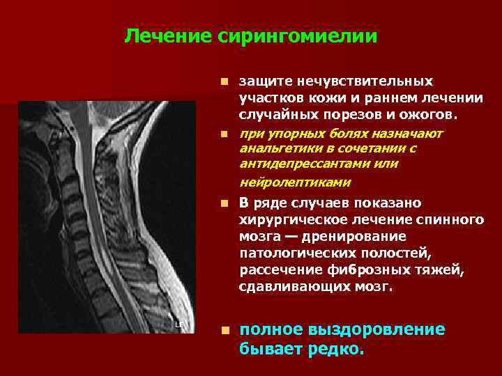 Гидромиелия шейного отдела