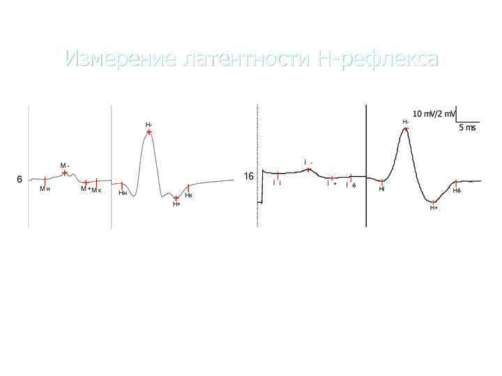   Измерение латентности Н-рефлекса Вариант формы Н-рефлекса 