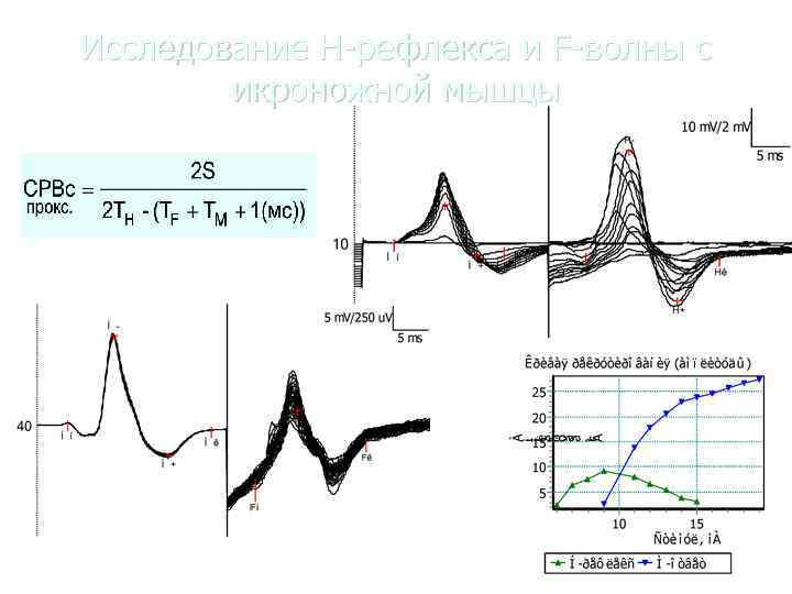 Исследование Н-рефлекса и F-волны с   икроножной мышцы  И. А. Скворцов (1984)