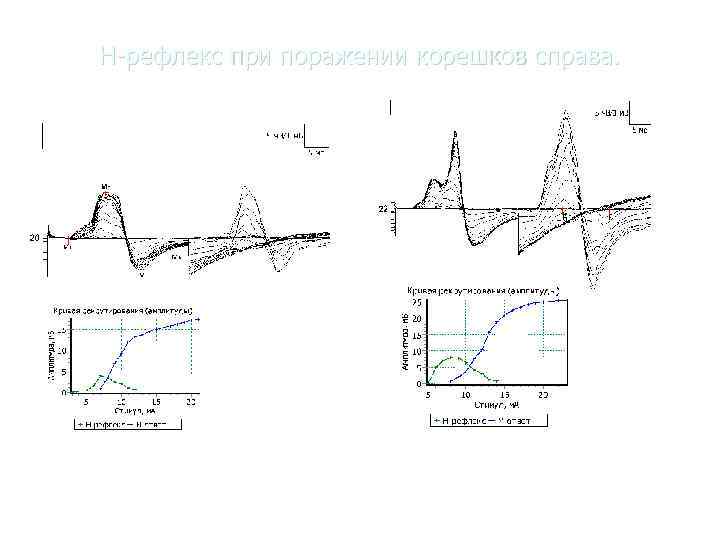        «Нейрософт»   Н-рефлекс при поражении корешков