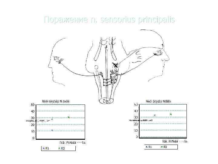 Поражение n. sensorius principalis 