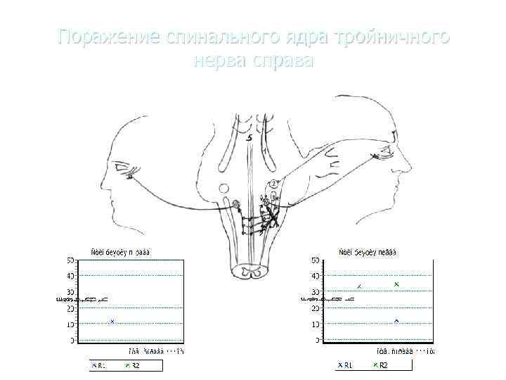 Поражение спинального ядра тройничного    нерва справа 
