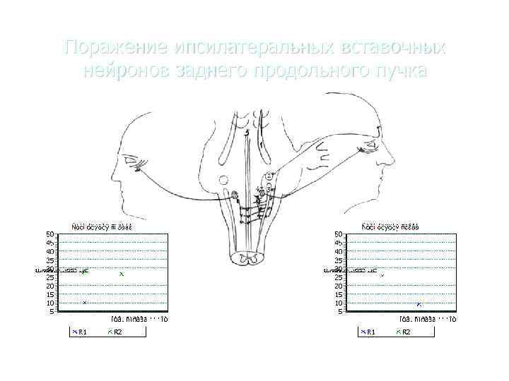 Поражение ипсилатеральных вставочных  нейронов заднего продольного пучка 