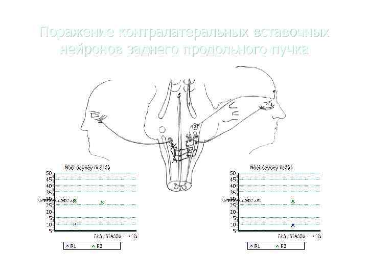 Поражение контралатеральных вставочных  нейронов заднего продольного пучка 