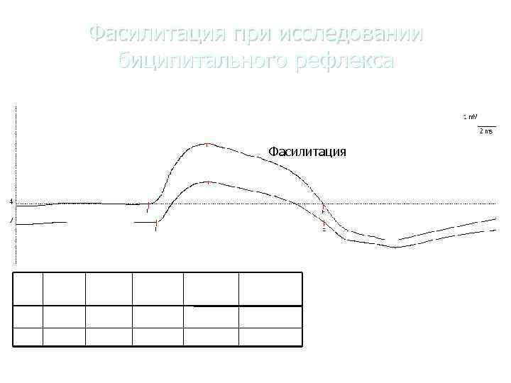   Фасилитация при исследовании    биципитального рефлекса    Фасилитация