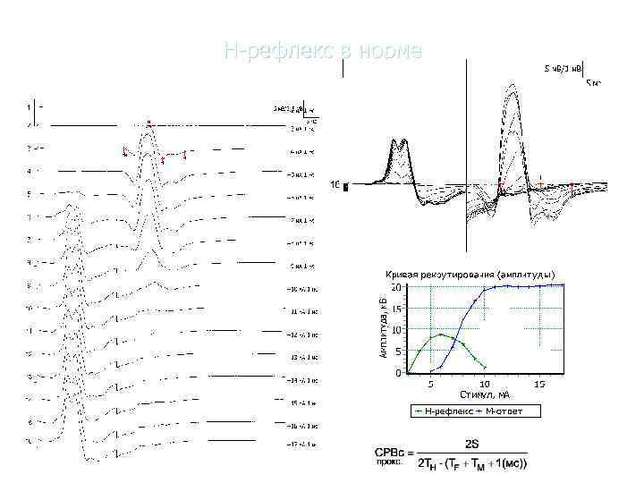      «Нейрософт» Н-рефлекс в норме 