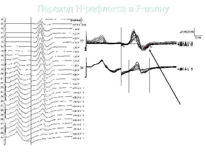Переход Н-рефлекса в F-волну    F -волна     
