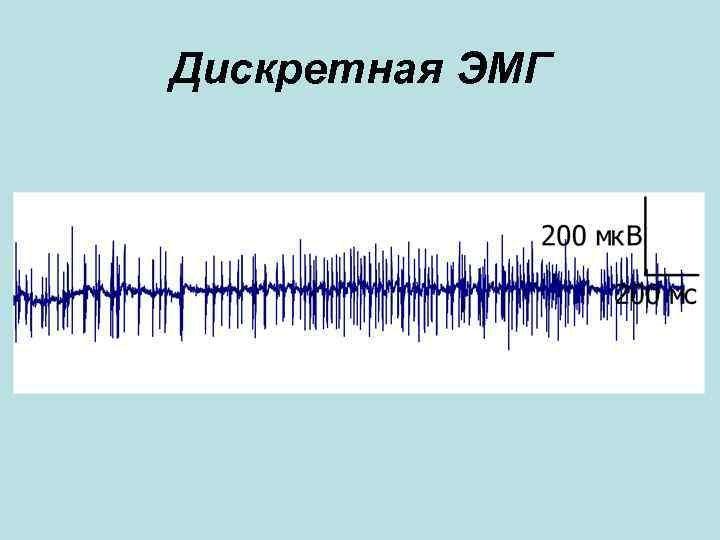 Дискретная ЭМГ Дискретная ЭМГ