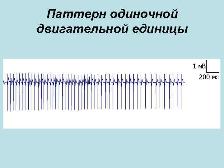 Паттерн одиночной двигательной единицы Паттерн одиночной двигательной единицы