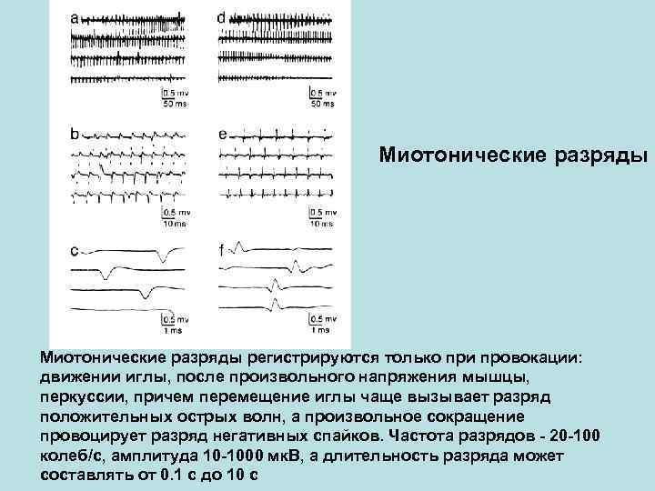 Миотонические разряды регистрируются только при провокации: движении Миотонические разряды регистрируются только при провокации: движении