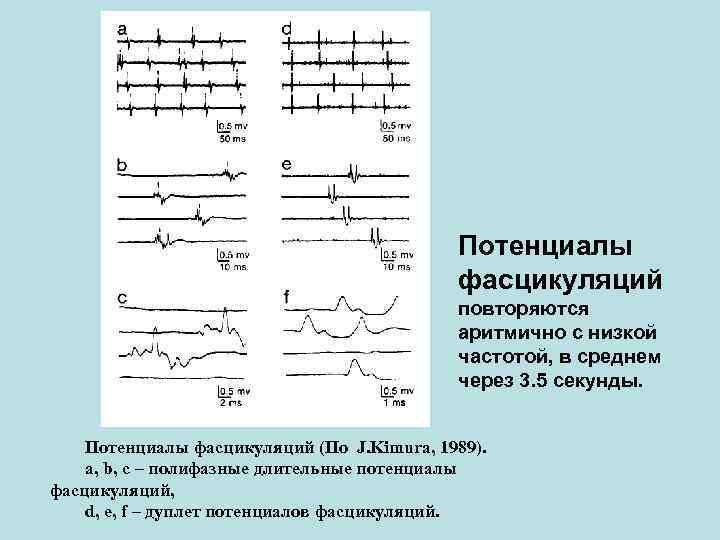 Потенциалы фасцикуляций Потенциалы фасцикуляций