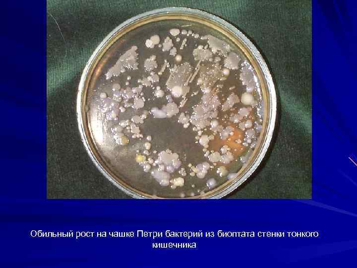 Обильный рост на чашке Петри бактерий из биоптата стенки тонкого    