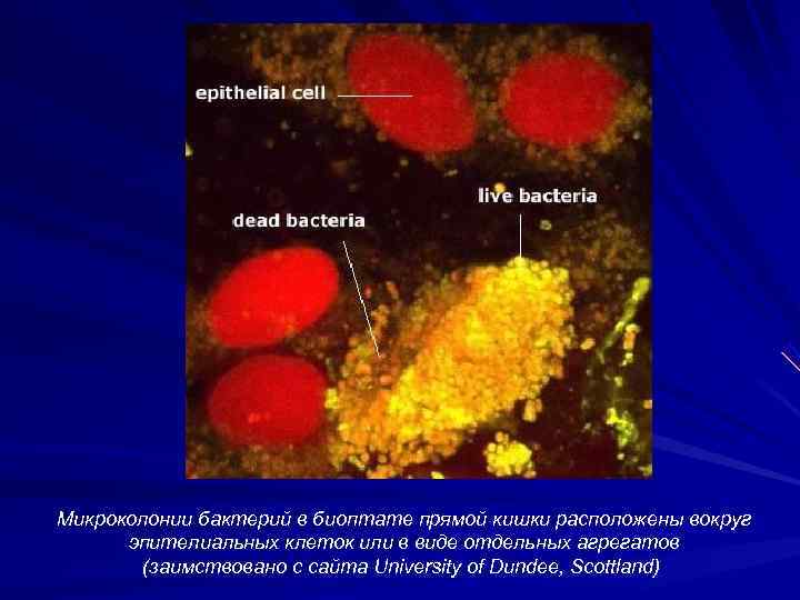 Микроколонии бактерий в биоптате прямой кишки расположены вокруг  эпителиальных клеток или в виде
