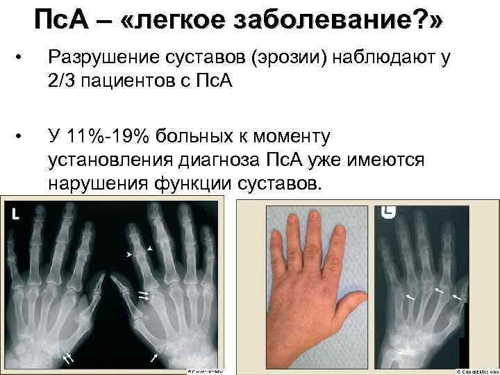   Пс. А – «легкое заболевание? »  •  Разрушение суставов (эрозии)