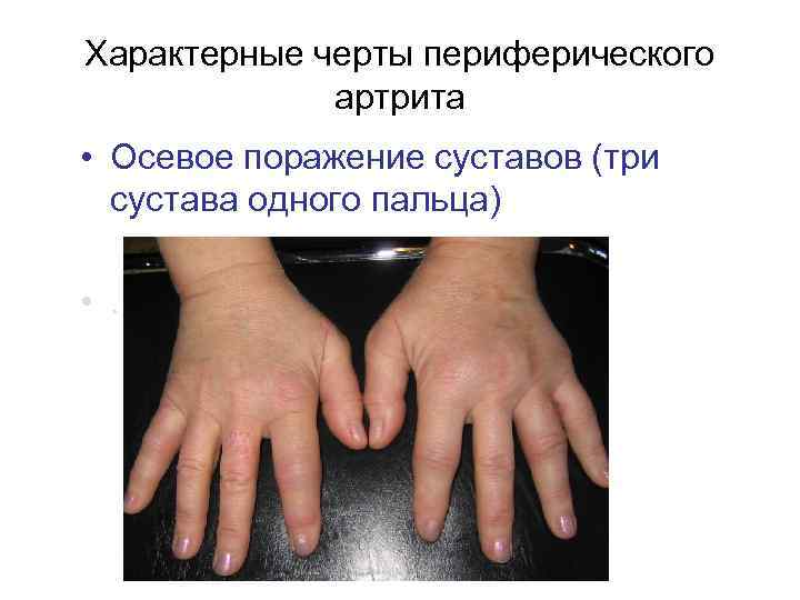 Характерные черты периферического   артрита • Осевое поражение суставов (три  сустава одного