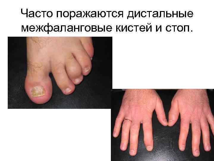 Часто поражаются дистальные межфаланговые кистей и стоп. 
