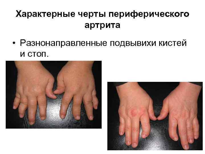 Характерные черты периферического   артрита • Разнонаправленные подвывихи кистей  и стоп. 