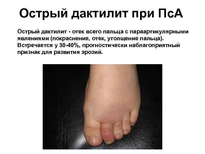 Острый дактилит при Пс. А Острый дактилит - отек всего пальца с параартикулярными явлениями